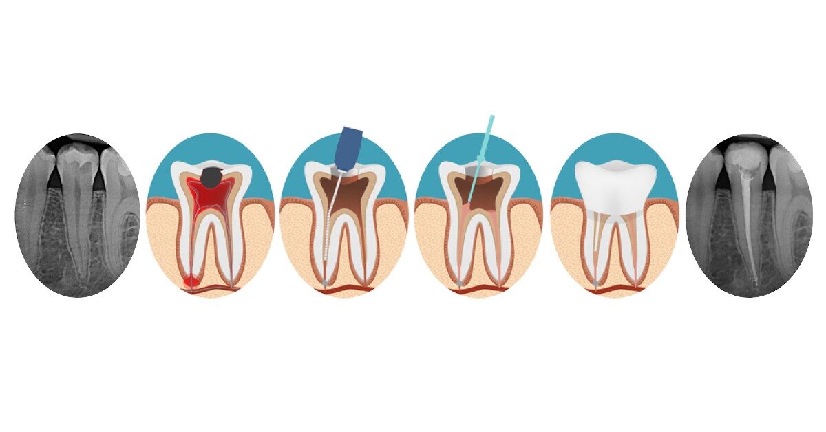 endodonzia